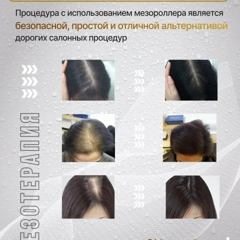 Дермароллер для роста и густоты волос с позолоченными иглами, Wheneva