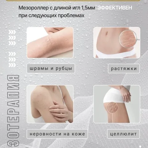 Дермароллер для роста и густоты волос с позолоченными иглами, Wheneva
