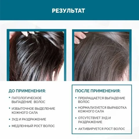 Спрей от выпадения для жирной кожи головы с цинком и кофеином, Rinfoltil